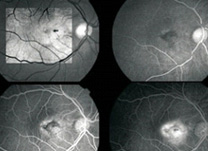 Angiofluoresceinografia, registro fotográfico do fundo de olho
