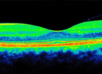 Tomografia de coerência óptica: exame para glaucoma, retinopatia e edema de papila