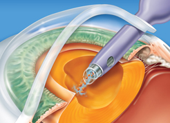 Conheça os tipos de cirurgias oculares