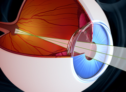 Cirurgia de retina e vítreo