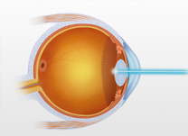 Correção Visual a Laser personalizada para o seu astigmatismo.